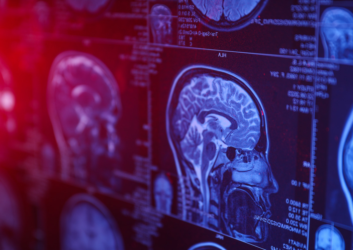MRI brain image